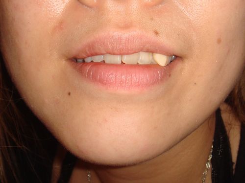 Oblique tooth After