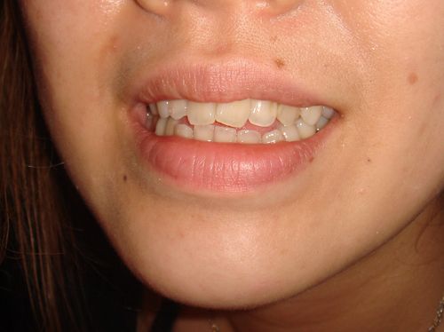 Oblique tooth Before